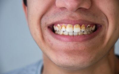 ¿Qué es la Necrosis Dental?
